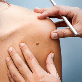 Skin Cancer Screenings