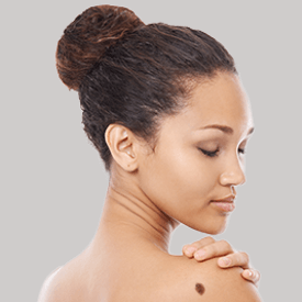 Warts and Moles
